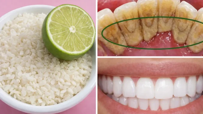 blanquear dientes casa bicarbonato — limón, dientes manchados y dientes blancos