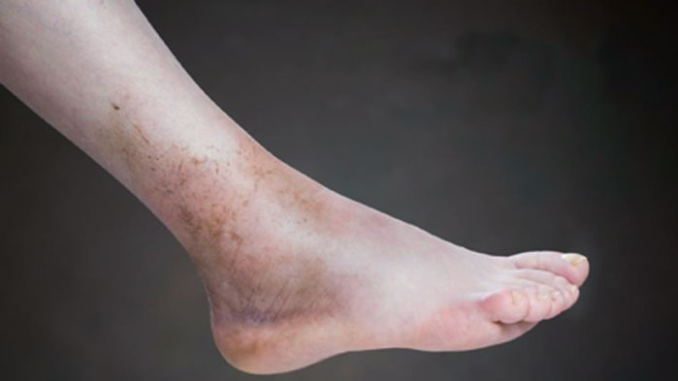 ejercicios para la mala circulacion en los pies, varices