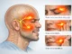 Ilustración del nervio trigémino y las tres ramas del nervio facial que causan la neuralgia del trigémino