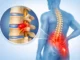hernia de disco síntomas tratamiento — ilustración anatómica de disco herniado comprimiendo el nervio