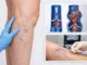 Piernas con varices visibles, diagrama de válvulas venosas sanas y dañadas, y procedimiento médico de tratamiento de varices