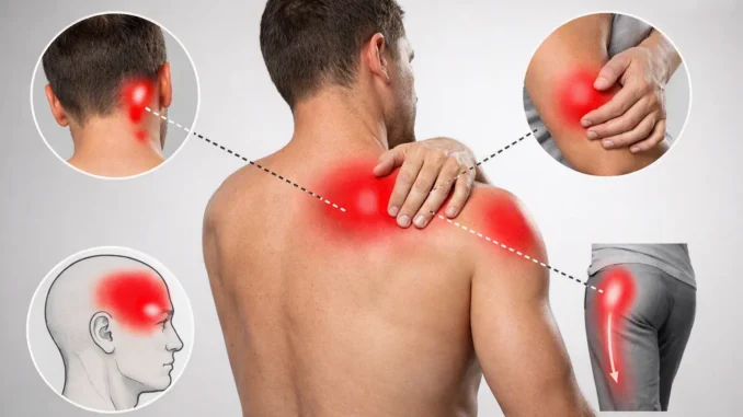 Diagrama de dolor referido muscular mostrando cómo un punto gatillo en el hombro refiere dolor a la nuca, la cabeza, el brazo y la pierna